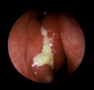 periorbital sinusitis complications